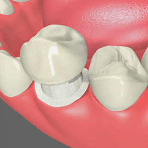 Porcelain Crowns